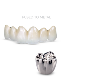 Obsidian 4x Fused to Metal y Coronas Metálicas